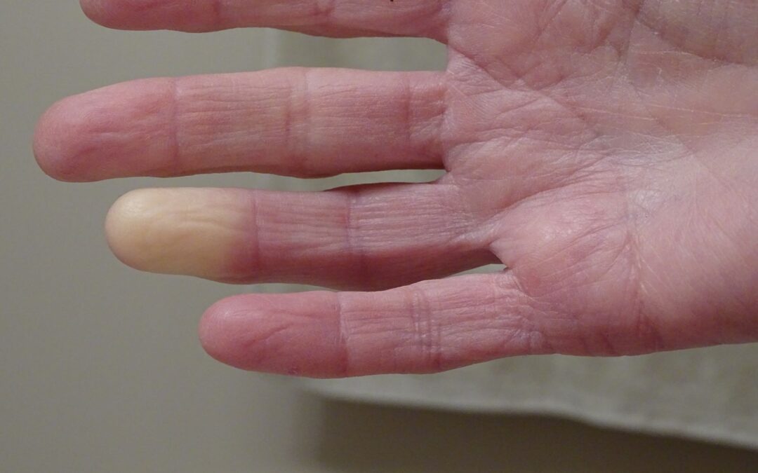 Raynaud’s Phenomenon: What is it, How it’s Diagnosed, and How’s Its Treated